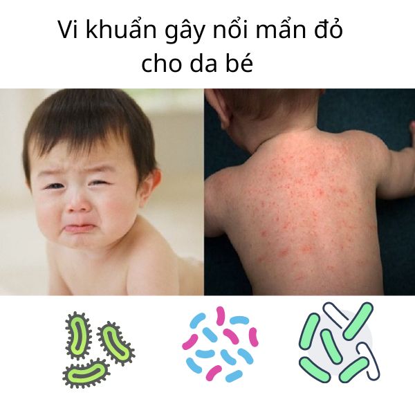 vi khuẩn gây dị ứng da bé