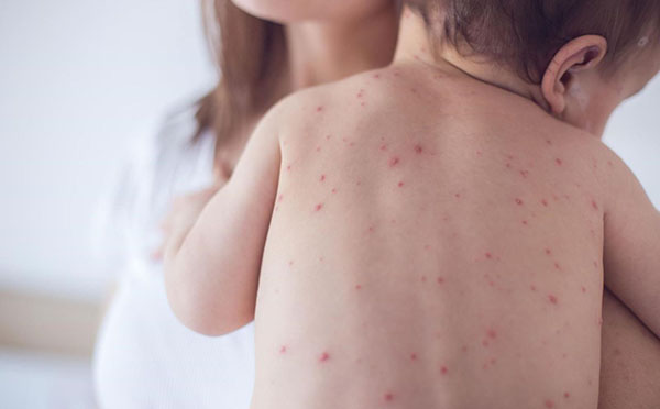 bệnh đậu mùa khỉ có nguy hiểm với trẻ nhỏ không