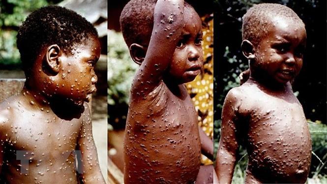 bệnh đậu mùa khỉ