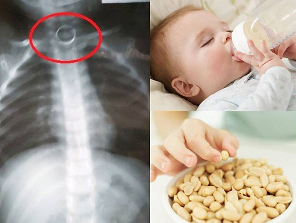 cách xử lý khi trẻ bị hóc dị vật