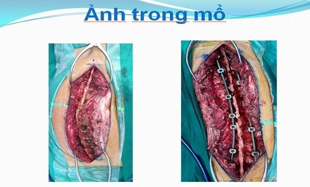 phẫu thuật xương cột sống
