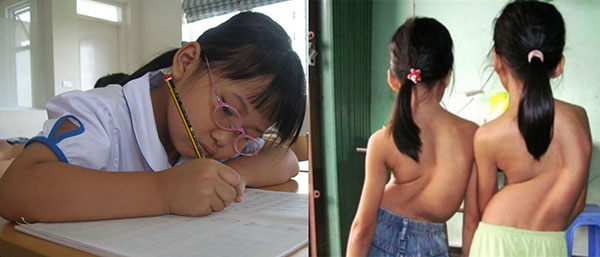 trẻ bị cong vẹo cột sống do ngồi sai tư thế