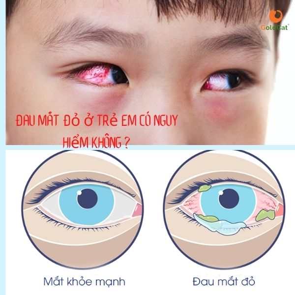 Bệnh đau mắt đỏ ở trẻ em và cách phòng tránh