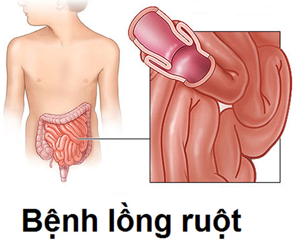 trẻ bị lồng ruột có nguy hiểm không