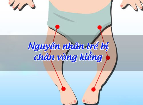trẻ em bị chân vòng kiềng