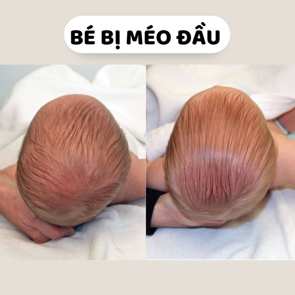trẻ sơ sinh bị méo đầu