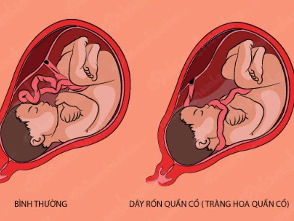 dây rốn quấn cổ