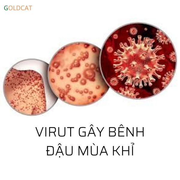 bệnh đậu mùa khỉ